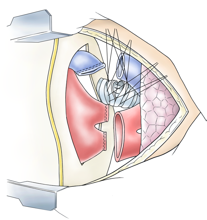 Illustration Implantation der Lunge