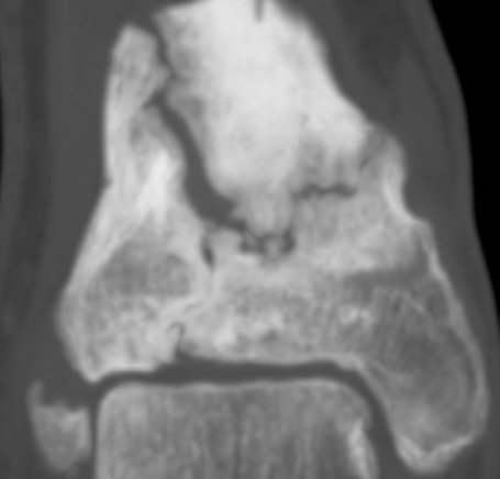 Röntgenaufnahme eines Bruchs