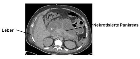 Computer-Tomographie (CT) einer schweren nekrotisierenden Bauchspeicheldrüsenentzündung (Pankreatitis)