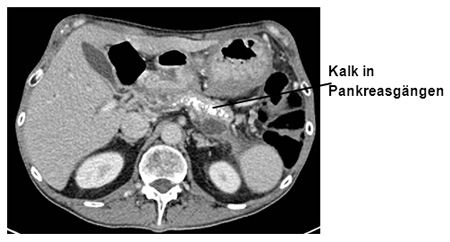 Computer-Tomographie (CT) einer chronischen kalzifizierenden Bauchspeicheldrüsenentzündung (Pankreatitis)
