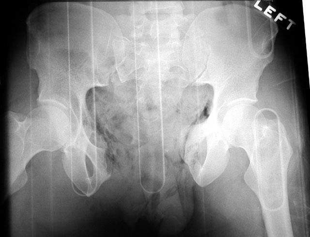 Röntgenbild open book-Verletzung