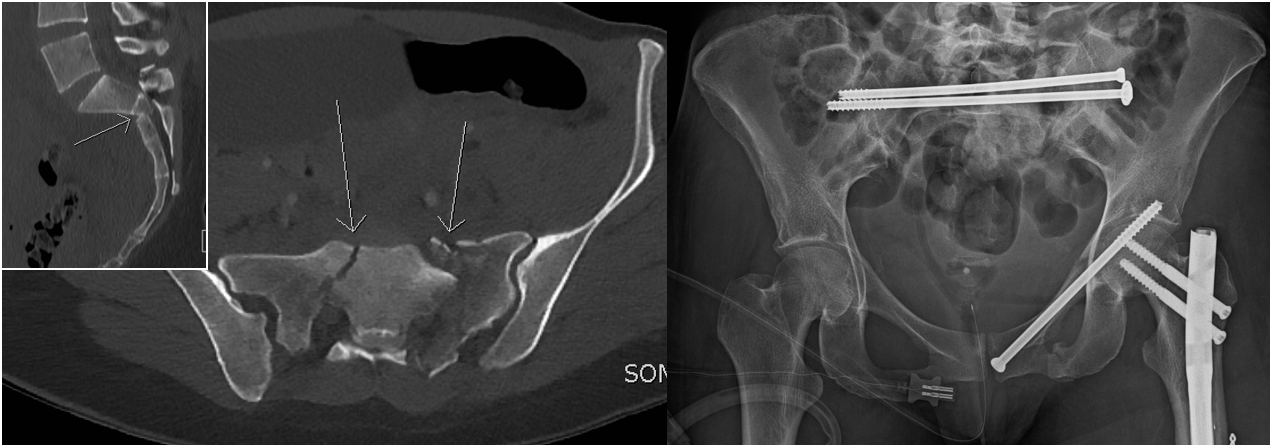 Links: Computertomographie nach Ausbruchverletzung des ersten Kreuzbeinwirbels. Rechts: Postoperatives Röntgen nach minimal-invasiver Stabilisation mittels langer Schrauben über kleine Hautschnitte.