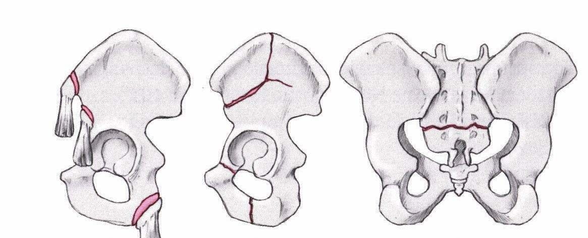 Illustration Stabile Beckenbrüche 