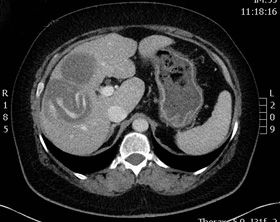 Computertomogramm der Leber mit Echinokokken