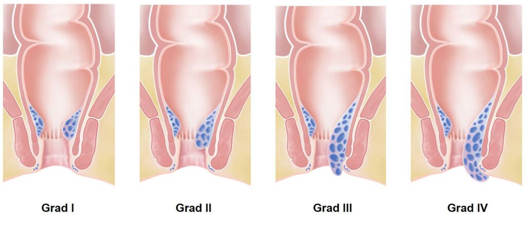 Illustration vergrösserte Hämorrhoiden