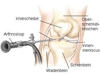Illustration Kniegelenks-Spiegelung (Arthroskopie):