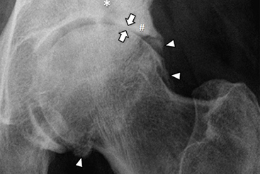 Röntgenbild Fortgeschrittene Hüftarthrose mit Gelenkspalt-verschmälerung (Pfeile), Knochenanbauten (Pfeilköpfe), Knochenverdichtungen (#) und Knochenzysten (*).