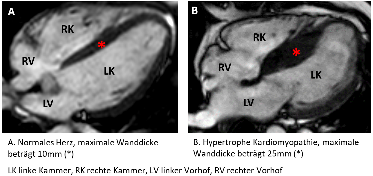 Heart muscle comparison