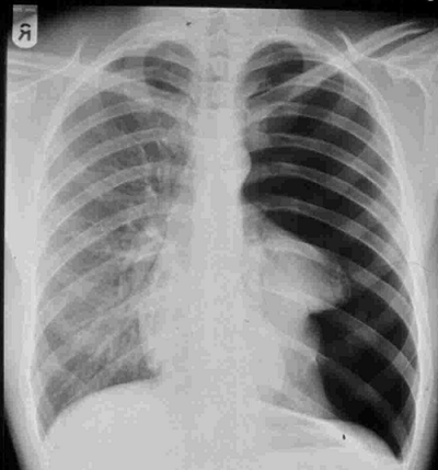 pneumothorax Röntgenbild