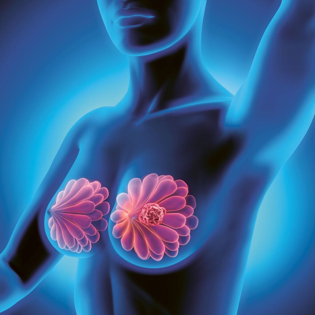 Illustration Brustdrüsen mit Brustkrebs