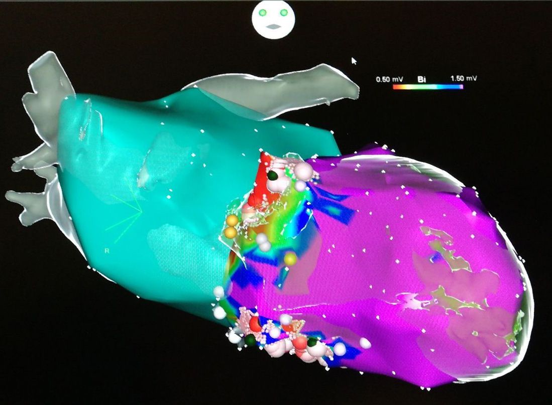 Verödung einer Kammertachykardie aus der linken Herzkammer (lila) «von innen» (endokardial) bei einem Patienten mit Herzmuskelschwäche (Ansicht von vorne). Der linke Vorhof ist grün dargestellt. Das 3-dimensionale Mapping ist mit dem CT des linken Ventrikels und linken Vorhofs überlagert (CARTO merge). Die roten und grün-blauen Areale stellen die Narbe dar, aus der die Kammertachykardien kommen. Rot/rosa sind die Verödungs (Ablations)punkte markiert.