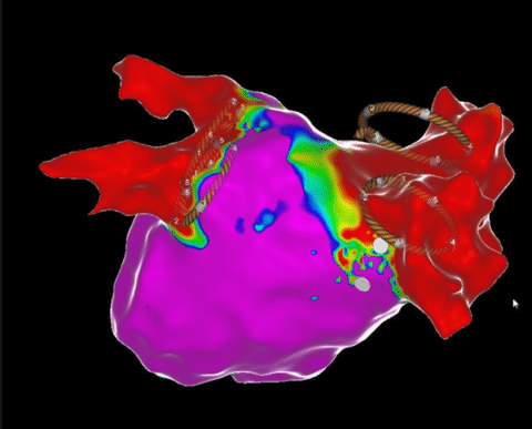 Abbildung 1: Katheter-basierte 3-D Mapping gesteuerte Ablation von Vorhofflimmern mit der neuen effizienten und schonenden Technologie der Pulsed Field Ablation (PFA, Elektroporation)