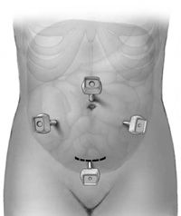 Working trocars and incision guidance during laparoscopic removal of the colon