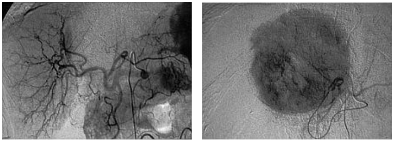 Chemoembolisation