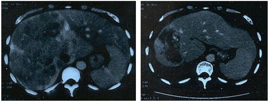Computertromogramm einer Leber vor und nach einer Chemotherapie