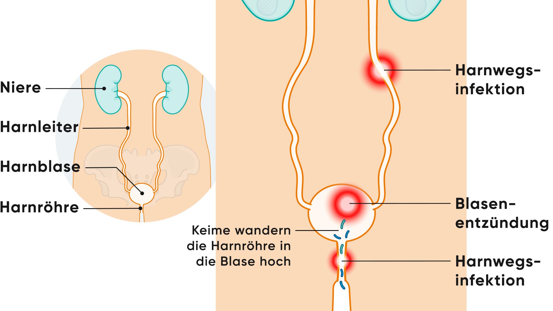 Illustration Blasenentzündung