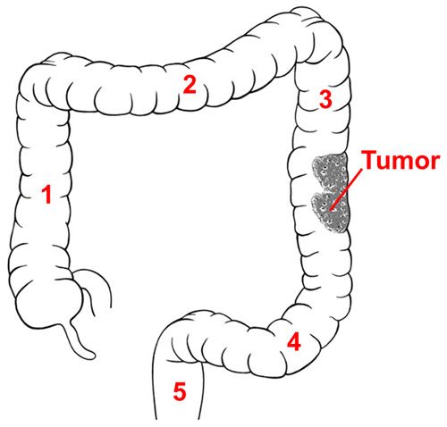 Visualization of a colon carcinoma