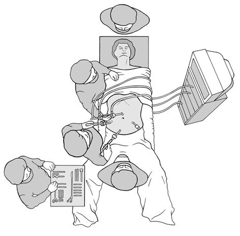 Visualization of a laparoscopic colon segment resection