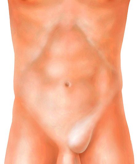 Visualization of an inguinal hernia