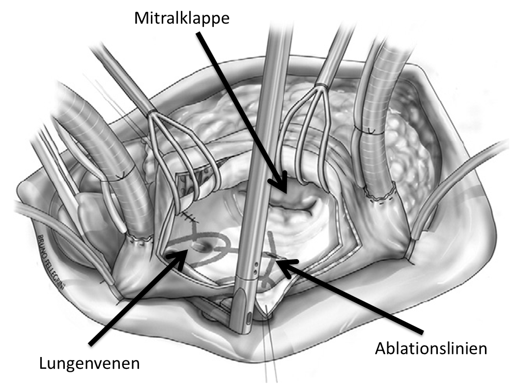 Schematische Darstellung des Operationssitus bei „stand alone“ Vorhofflimmern Ablation