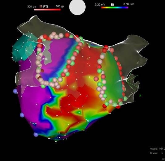 Vorhofflimmerablation: 3D elektroanatomisches Mapping mit dem CT Bild des linken Vorhofs überlagert (CT-merge, Blick von hinten auf den linken Vorhof) unterstützen die Katheternavigation und Ablation (rote/rosa Punkte). Die Lungenvenenostien sind grün markiert. Das linke Vorhofsohr ist dunkelgrün dargestellt.