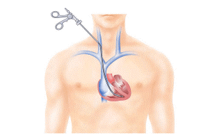 Sketch of heart muscle biopsy