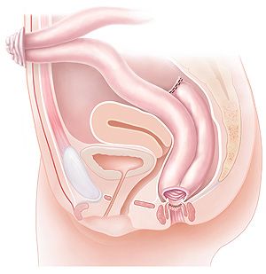 Illustration of a total coloproctectomy