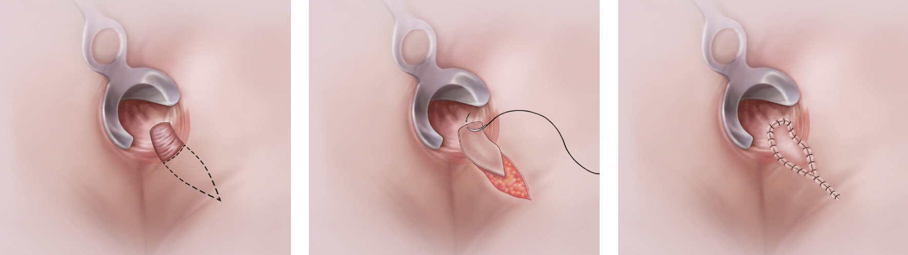 V-Y Flap: Abdeckung eines Risses mit einem Hautlappen