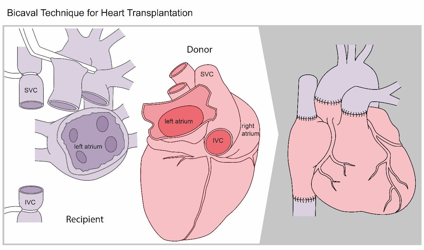 Operationsskizze Herztransplantation