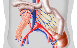 Illustration pancreas transplantation