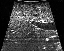 Ultraschallgesteuerte Radiofrequenzablation eins Lebertumors