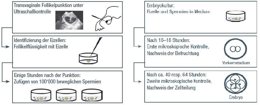 Ablauf der In-vitro-Fertilisation