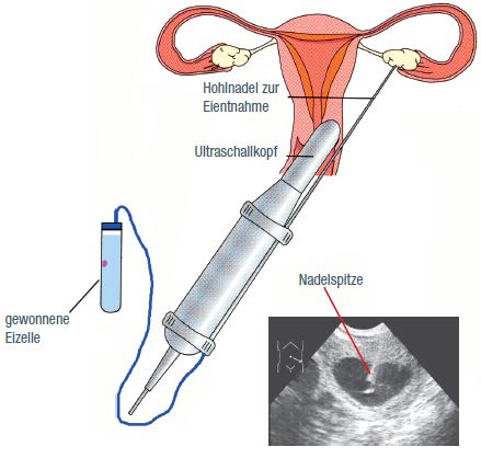 Transvaginale Follikelpunktion unter Ultraschallkontrolle