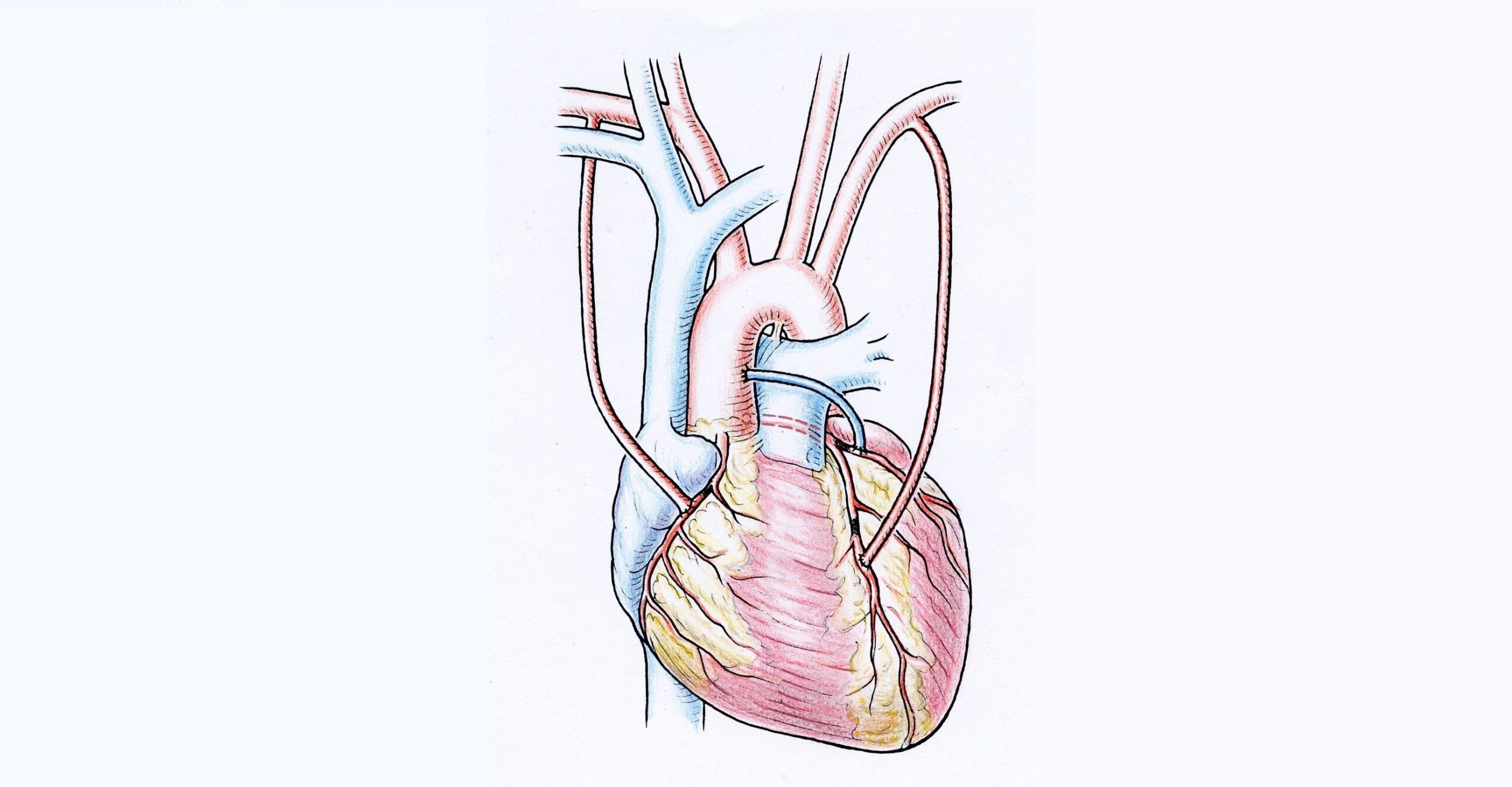 Example of a bypass operation using both thoracic arteries and a leg vein