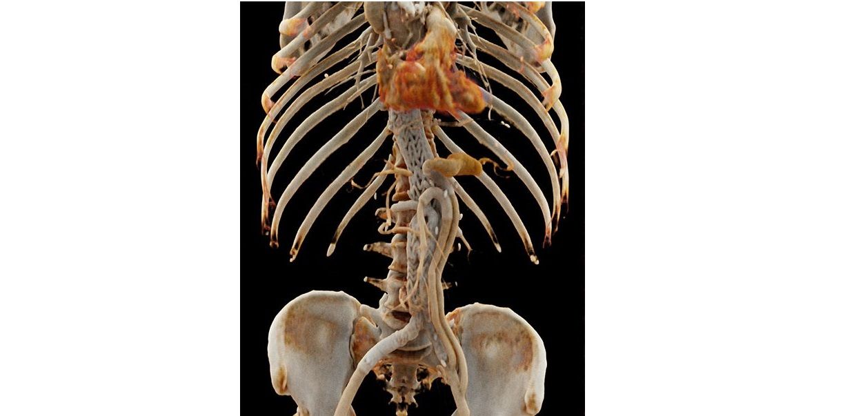 3D image (cinematic rendering) of a CT angiography of a patient after endovascular stent placement in the abdominal aorta by interventional radiology.