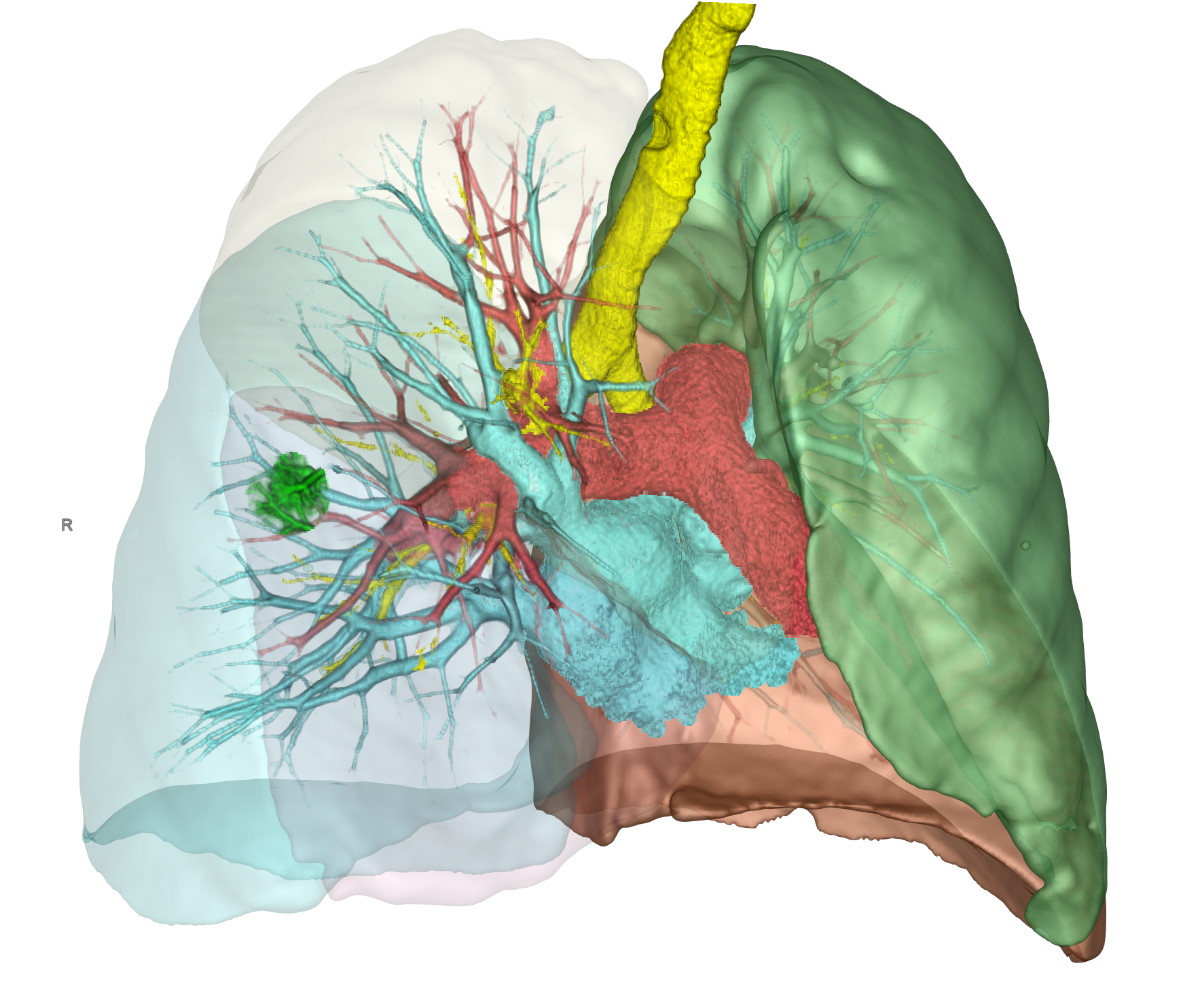 3D-Darstellung der Lunge und des zu resezierenden Tumors