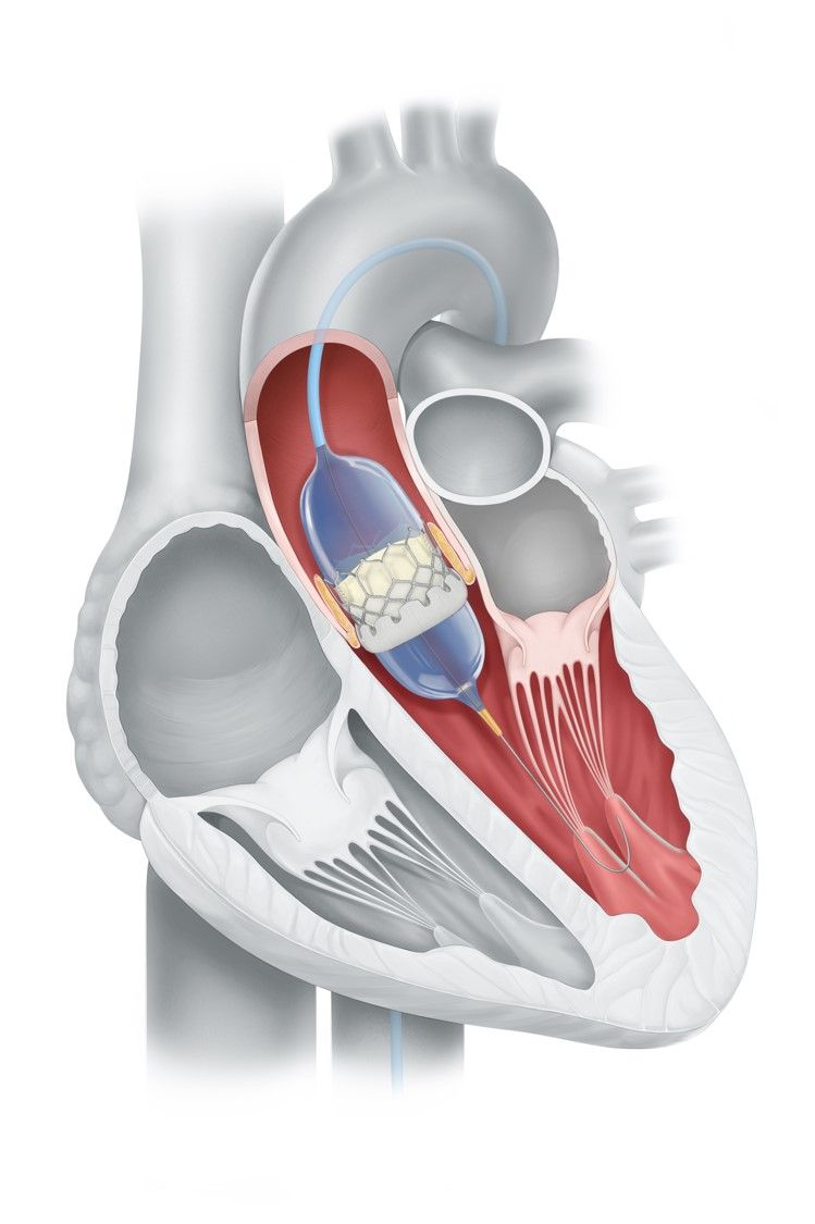 TAVI: Ballon-Kathetersystem mit biologischer Aortenklappenprothese während Implantation