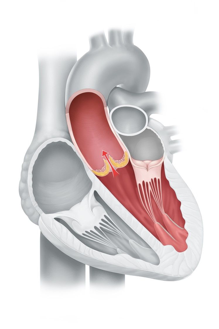 Schwere Aortenklappenstenose: Der Blutfluss von der Herzkammer in Richtung Hauptschlagader Aorta ist deutlich behindert