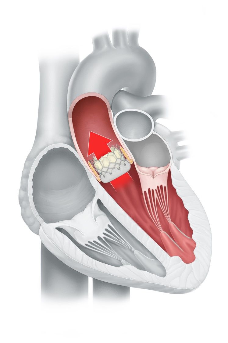 Biologische Aortenklappe in Position mit normalem Blutfluss von der Herzkammer zur Hauptschlagader Aorta