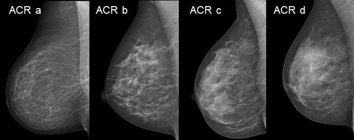 Different breast densities