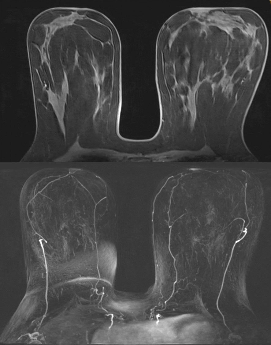 Grafik von Brustgewebe bei Supplemental Screening