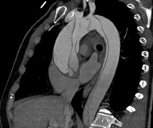 CT-Angiographie eines Patienten mit akuter Typ A Dissektion.