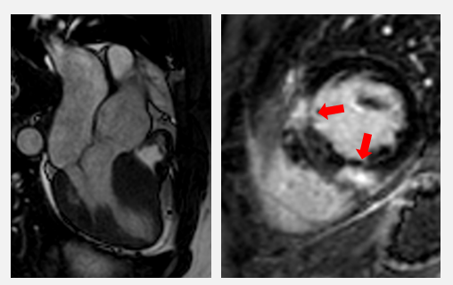 Cardiac MRI of a patient with HCM. There is clear hypertrophy of the septum (left) and typical fibrosis, emphasized at the base of the right ventricle (right, red arrows).