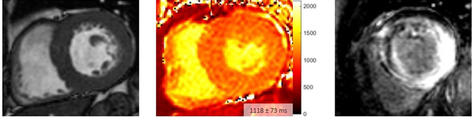 Typisches Bild einer kardialen Amyloidose in der Herz-MRI mit konzentrischer Hypertrophie (links), deutlich erhöhtem T1-Mapping (Mitte) und ausgeprägtem myokardialem late gadolinium enhancement (LGE, rechts).
