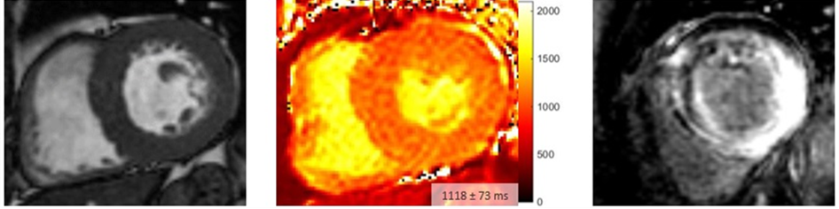 Typical image of cardiac amyloidosis in cardiac MRI with concentric hypertrophy (left), significantly increased T1 mapping (center) and pronounced myocardial late gadolinium enhancement (LGE, right).