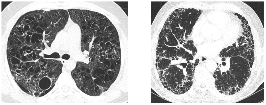Zystische Lungenveränderungen bei Langerhanszell-Histiozytose und Lungenfibrose, Typ UIP