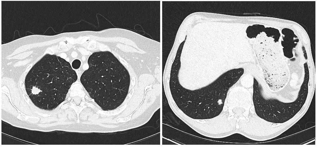 Darstellung zweier Lungentumore im Frühstadium