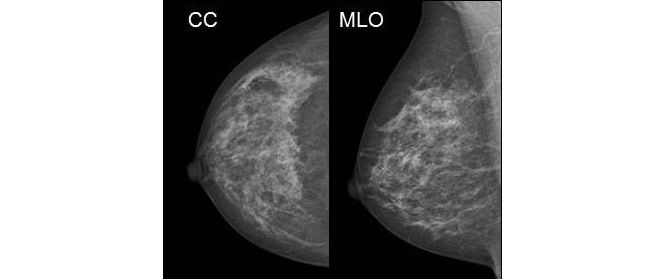 Projections of the mammography image