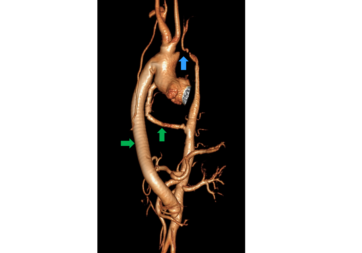 Abbildung 3: MRI Angiographie der Aorta eines Patienten mit schwerer Aortenisthmusstenose (blauer Pfeil) und operativer Anlage zweier extra-anatomischer Aorten-Bypässe (grüne Pfeile).