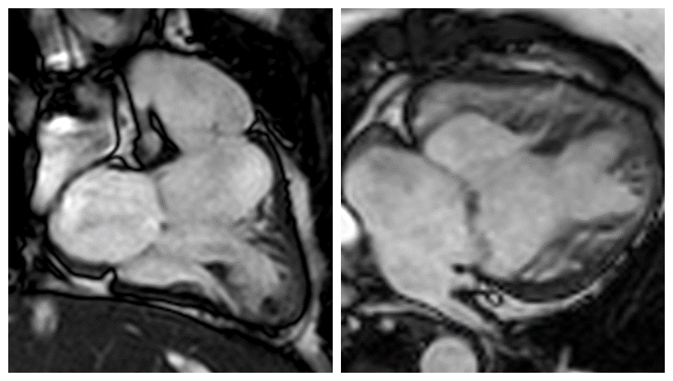 Abbildung 2: MRI Funktionsaufnahmen (SSFP cine) eines Patienten mit Hypoplastischem Linksherzsyndrom und operativer Umstellung der Versorgung des Systemkreislaufs auf die rechte Herzkammer («Fontan-Zirkulation»). 